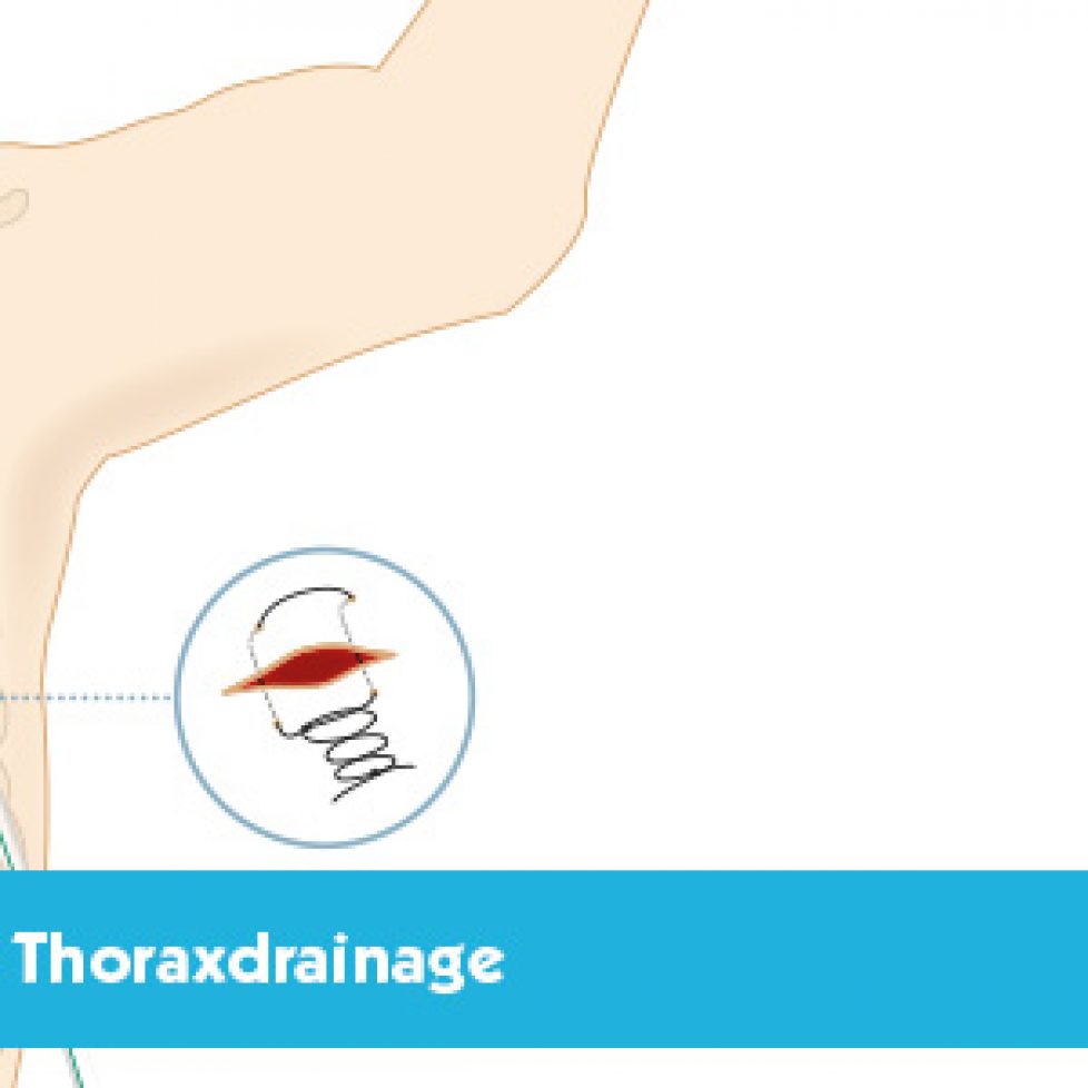 thoraxdrainage-safety-blog-700x300